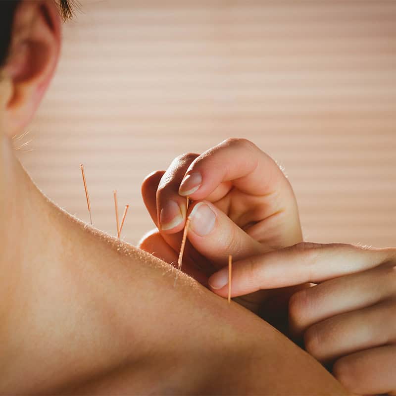shak the physio greystanes what is dry needling physiotherapy services pemulway prospect